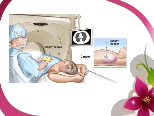 Biopsies in lung cancer diagnosis process