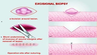BIOPSY | PPTX