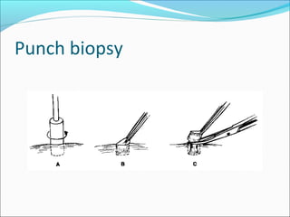 Biopsy | PPT