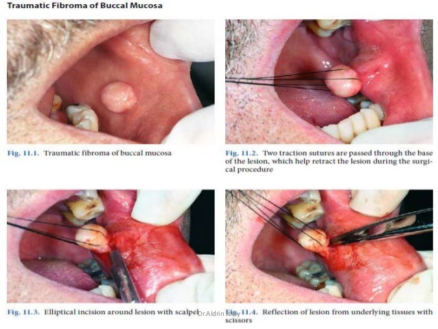 picture Punch Biopsy Tongue oral biopsy