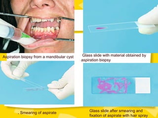 Aspiration biopsy from a mandibular cyst Glass slide with material obtained by
aspiration biopsy
Glass slide after smearing and
fixation of aspirate with hair spray
. Smearing of aspirate
 