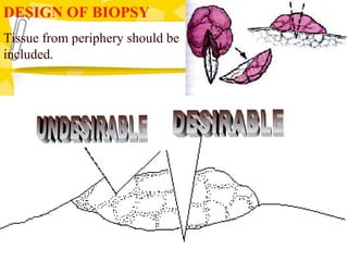 DESIGN OF BIOPSY
Tissue from periphery should be
included.
 