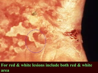 For red & white lesions include both red & white
area
 