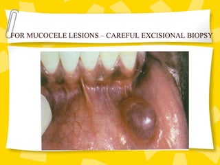 FOR MUCOCELE LESIONS – CAREFUL EXCISIONAL BIOPSY
 