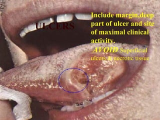 ULCERS
Include margin,deep
part of ulcer and site
of maximal clinical
activity.
AVOID Superficial
ulcers & necrotic tissue
 