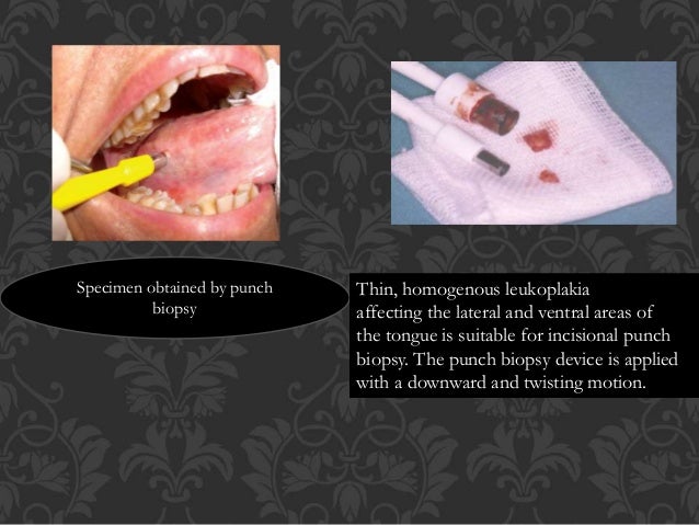 photo Punch Biopsy Tongue oral biopsy