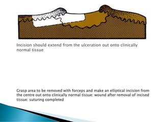 Biopsy | PDF