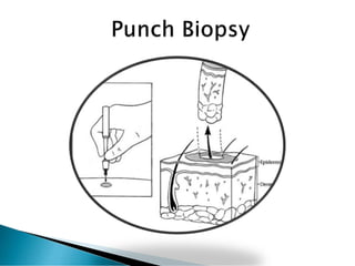 Punch Method Biopsy | PDF