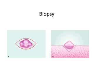 Biopsy
 