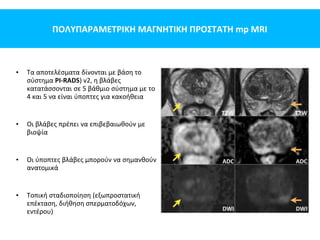ΠΟΛΥΠΑΡΑΜΕΤΡΙΚΗ ΜΑΓΝΗΤΙΚΗ ΠΡΟΣΤΑΤΗ mp MRI
• Τα αποτελέσματα δίνονται με βάση το
σύστημα PI-RADS) v2, η βλάβες
κατατάσσονται σε 5 βάθμιο σύστημα με το
4 και 5 να είναι ύποπτες για κακοήθεια
• Οι βλάβες πρέπει να επιβεβαιωθούν με
βιοψία
• Οι ύποπτες βλάβες μπορούν να σημανθούν
ανατομικά
• Τοπική σταδιοποίηση (εξωπροστατική
επέκταση, διήθηση σπερματοδόχων,
εντέρου)
 