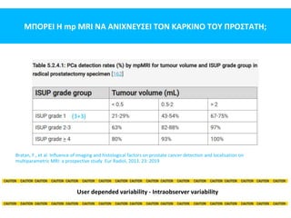 ΜΠΟΡΕΙ Η mp MRI ΝΑ ΑΝΙΧΝΕΥΣΕΙ ΤΟΝ ΚΑΡΚΙΝΟ ΤΟΥ ΠΡΟΣΤΑΤΗ;
Bratan, F., et al. Influence of imaging and histological factors on prostate cancer detection and localisation on
multiparametric MRI: a prospective study. Eur Radiol, 2013. 23: 2019
(3+3)
User depended variability - Intraobserver variability
 