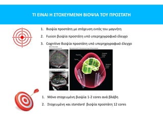 ΤΙ ΕΙΝΑΙ Η ΣΤΟΧΕΥΜΕΝΗ ΒΙΟΨΙΑ ΤΟΥ ΠΡΟΣΤΑΤΗ
1. Βιοψία προστάτη με στόχευση εντός του μαγνήτη
2. Fusion βιοψία προστάτη υπό υπερηχογραφικό έλεγχο
3. Cognitive Βιοψία προστάτη υπό υπερηχογραφικό έλεγχο
1. Μόνο στοχευμένη βιοψία 1-2 cores ανά βλάβη
2. Στοχευμένη και standard βιοψία προστάτη 12 cores
 