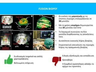 FUSION BIOPSY
• Οι εικόνες της μαγνητικής με τις
ύποπτες περιοχές επεξεργάζονται σε
3D μοντέλο
• Με τη χρήση υπερήχου δημιουργείται
ένα 3D μοντέλο real time
• Το λογισμικό συνενώνει τα δύο
μοντέλα διορθώνοντας τις αποκλείσεις
τους
• Δυνατότητα εικονικής λήψης βιοψίας
• Στερεοτακτική απεικόνιση της περιοχής
λήψης της πραγματικής βιοψίας
Συνδυασμός targeted και απλής
χαρτογράφησης
Βελτιωμένη στόχευση
Ειδικός εξοπλισμός και εκπαίδευση
Χρονοβόρα
Η διορθική προσπέλαση αλλάζει το
σχήμα του προστάτη
 