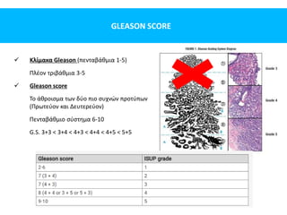 GLEASON SCORE
 Κλίμακα Gleason (πενταβάθμια 1-5)
Πλέον τριβάθμια 3-5
 Gleason score
Το άθροισμα των δύο πιο συχνών προτύπων
(Πρωτεύον και Δευτερεύον)
Πενταβάθμιο σύστημα 6-10
G.S. 3+3 < 3+4 < 4+3 < 4+4 < 4+5 < 5+5
 