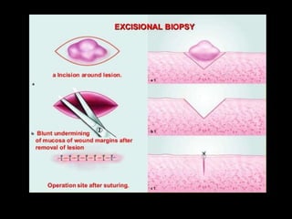 Biopsy for presentation | PPT