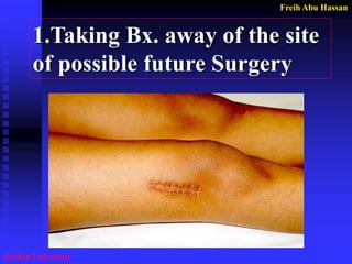 Freih Abu Hassan 
Jordan University 
1.Taking Bx. away of the site 
of possible future Surgery  