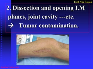 Freih Abu Hassan 
Jordan University 
2. Dissection and opening I.M 
planes, joint cavity ---etc. 
 Tumor contamination.  