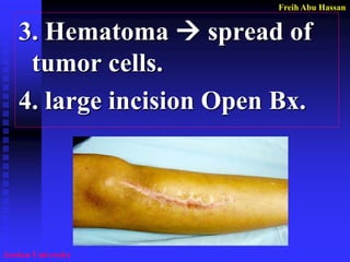 Freih Abu Hassan 
Jordan University 
3. Hematoma  spread of tumor cells. 
4. large incision Open Bx.  