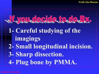 Freih Abu Hassan 
Jordan University 
1- Careful studying of the 
imagings 
2- Small longitudinal incision. 
3- Sharp dissection. 
4- Plug bone by PMMA.  