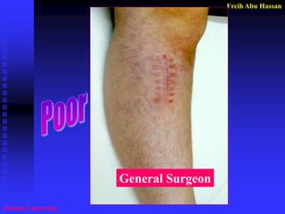 Freih Abu Hassan 
Jordan University 
General Surgeon  