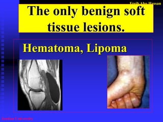 Freih Abu Hassan 
Jordan University 
The only benign soft tissue lesions. 
Hematoma, Lipoma  