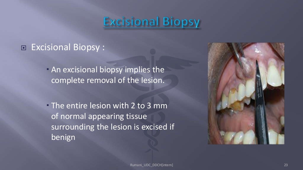 Biopsy in Oral Surgery