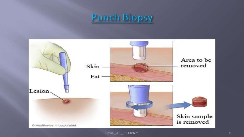 Biopsy in Oral Surgery