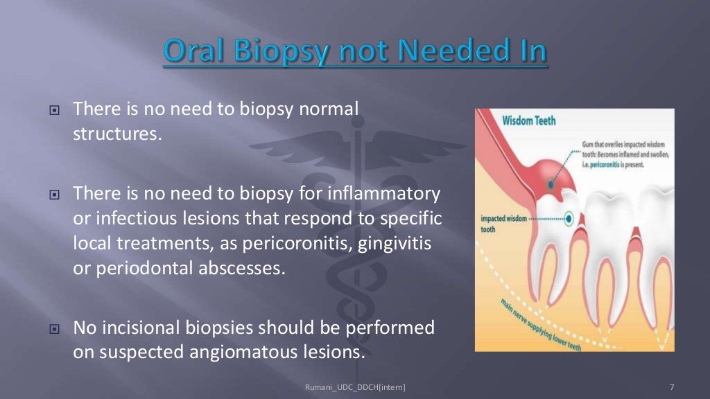 Biopsy in Oral Surgery