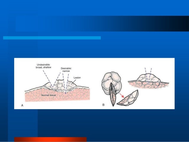 Principles And Techniques Of Biopsy
