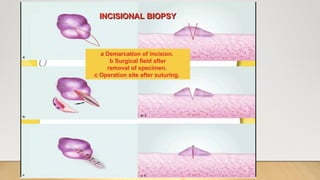 BIOPSY IN SURGERY 1 [Auto-savedd] 3.pptx