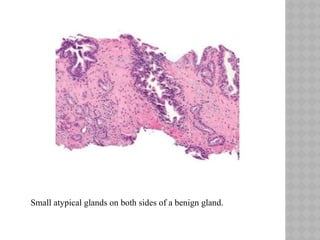Biopsy interpretation of prostate disease | PPTX