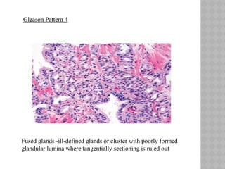 Prostate Pattern 4 Patterns Biopsy interpretation of prostate disease | PPTX