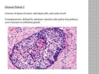 Prostate Pattern 5 Biopsy interpretation of prostate disease | PPTX