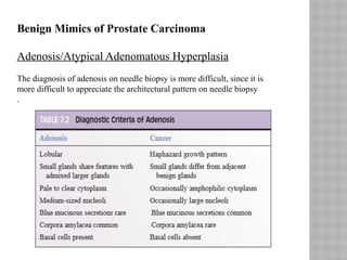 Biopsy interpretation of prostate disease | PPTX