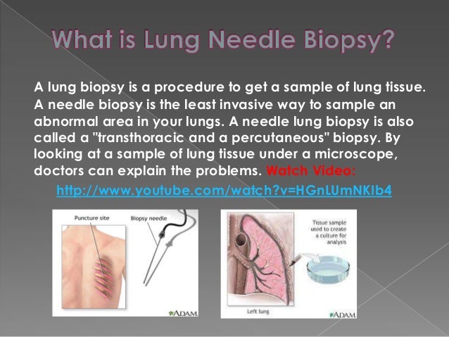 What is a biopsy?