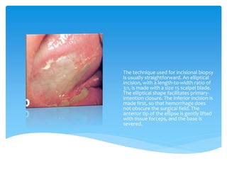 Elliptical Incisional Biopsy techniques in oral surgery | PPTX
