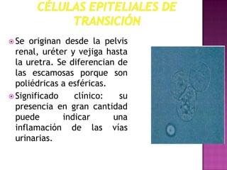  Se

originan desde la pelvis
renal, uréter y vejiga hasta
la uretra. Se diferencian de
las escamosas porque son
poliédricas a esféricas.
 Significado
clínico:
su
presencia en gran cantidad
puede
indicar
una
inflamación de las vías
urinarias.

 