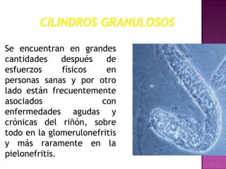 Se encuentran en grandes
cantidades
después
de
esfuerzos
físicos
en
personas sanas y por otro
lado están frecuentemente
asociados
con
enfermedades agudas y
crónicas del riñón, sobre
todo en la glomerulonefritis
y más raramente en la
pielonefritis.

 