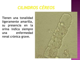 Tienen una tonalidad
ligeramente amarilla,
su presencia en la
orina indica siempre
una
enfermedad
renal crónica grave.

 