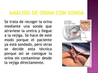 Se trata de recoger la orina
mediante una sonda que
atraviese la uretra y llegue
a la vejiga. Se hace de este
modo porque el paciente
ya está sondado, pero otras
se decide esta técnica
porque así se consigue la
orina sin contaminar desde
la vejiga directamente.

 