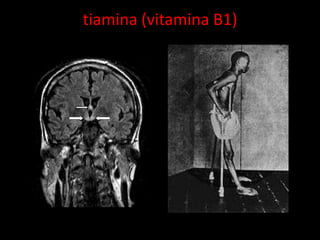 tiamina (vitamina B1)