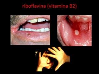 riboflavina (vitamina B2)