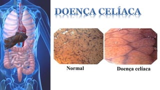 Normal Doença celíaca 
 