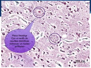 Placa neurítica
  Con un anillo de
 neuritas distróficas
rodeando un núcleo
      amiloideo
 