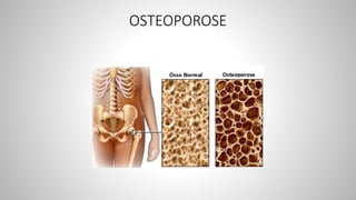 OSTEOPOROSE
 
