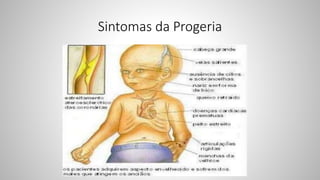Sintomas da Progeria
 