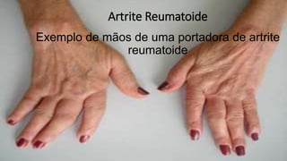 Artrite Reumatoide
Exemplo de mãos de uma portadora de artrite
reumatoide
 