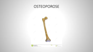 OSTEOPOROSE
 