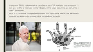 A origem do OCA1A está associada a mutações no gene TYR, localizado no cromossomo 11.
Esse gene codifica a tirosinase, enzima indispensável na cadeia bioquímica que transforma a
tirosina em melanina.
No OCA1A, a tirosinase é completamente inativa. Isso significa que, mesmo com melanócitos
presentes, o organismo não consegue iniciar a produção do pigmento.
 