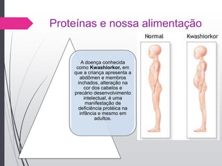 Proteínas e nossa alimentação
A doença conhecida
como Kwashiorkor, em
que a criança apresenta a
abdômen e membros
inchados, alteração na
cor dos cabelos e
precário desenvolvimento
intelectual, é uma
manifestação de
deficiência protéica na
infância e mesmo em
adultos.
 